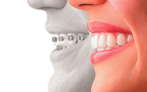 Invisalign for Teens in Staten Island